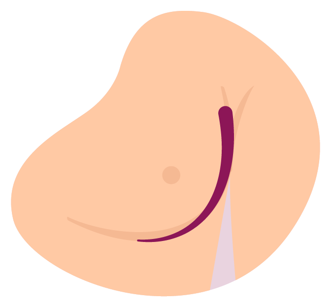 Thickening of the breast or underarm