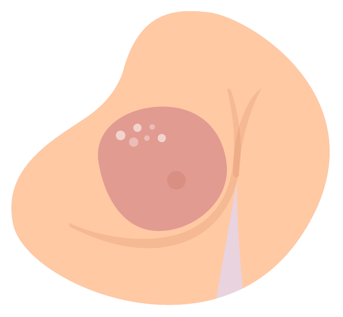 Redness of the breasts, swelling and increased temperature