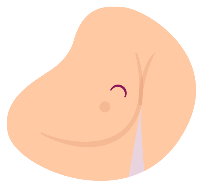 Breast lump